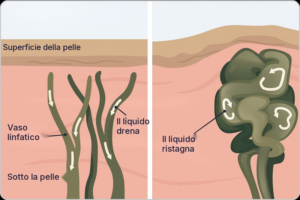 Vaso linfatico che drena e vaso in cui il liquido ristagna
